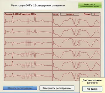 ЭКГ 12 отведений